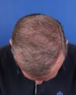 After Hair Transplant &nbsp;2 Sessions (Areas)